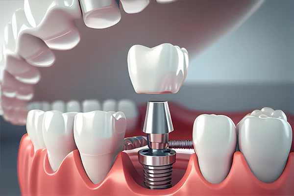 Implantológia Eurodent